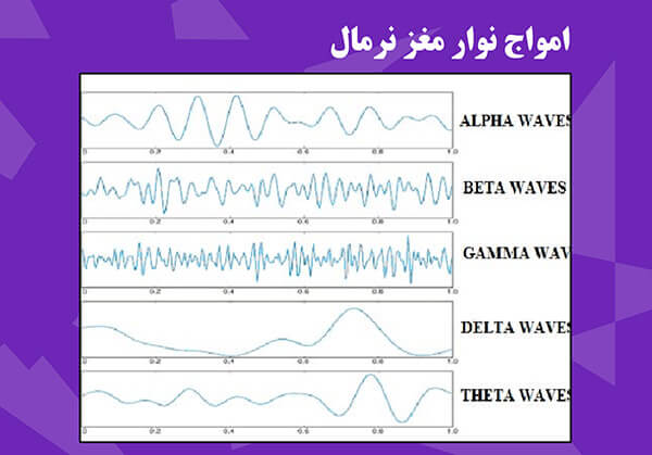 نوار مغزی یا الکتروانسفالوگرافی
